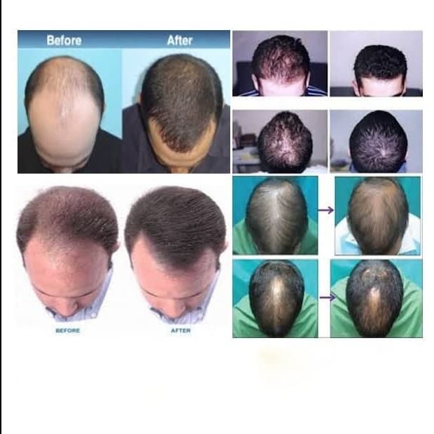 Minoxidil "Kirkland" (6х60ml) 3