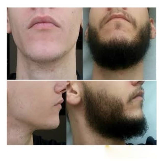 Minoxidil "Kirkland" (6х60ml) 2